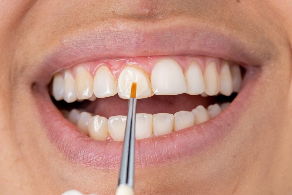 Kompozitinis bondinimas